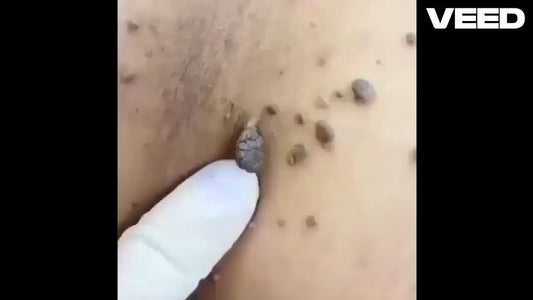 WartsOff Instant Blemish Removal Cream Pack of 2